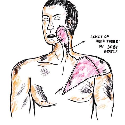 pectoralis major lappen|Does Pectoralis Major Myocutaneous Flap Cause the Shoulder。